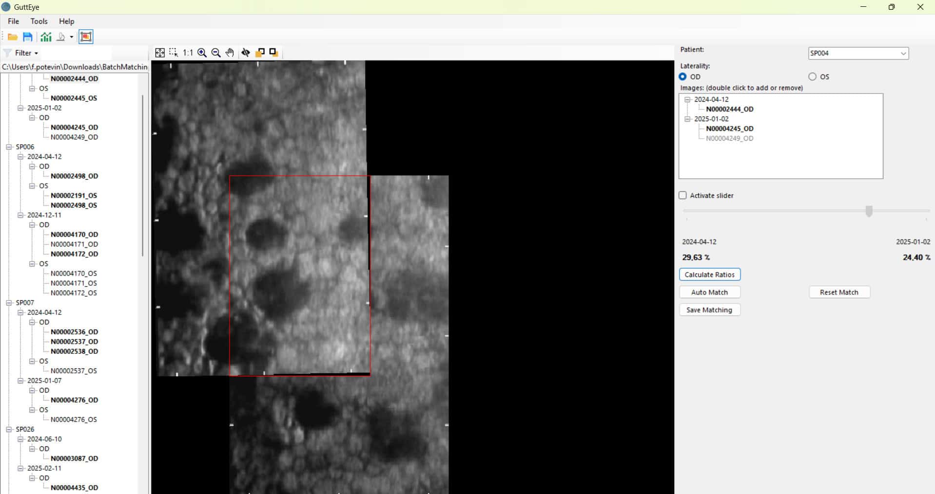 Automatic image alignement : Since guttae are not evenly distributed across the cornea, it is essential to be able to compare the evolution of the GAR% FECD score over time in common cellular areas.